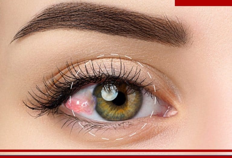 Glaucoma