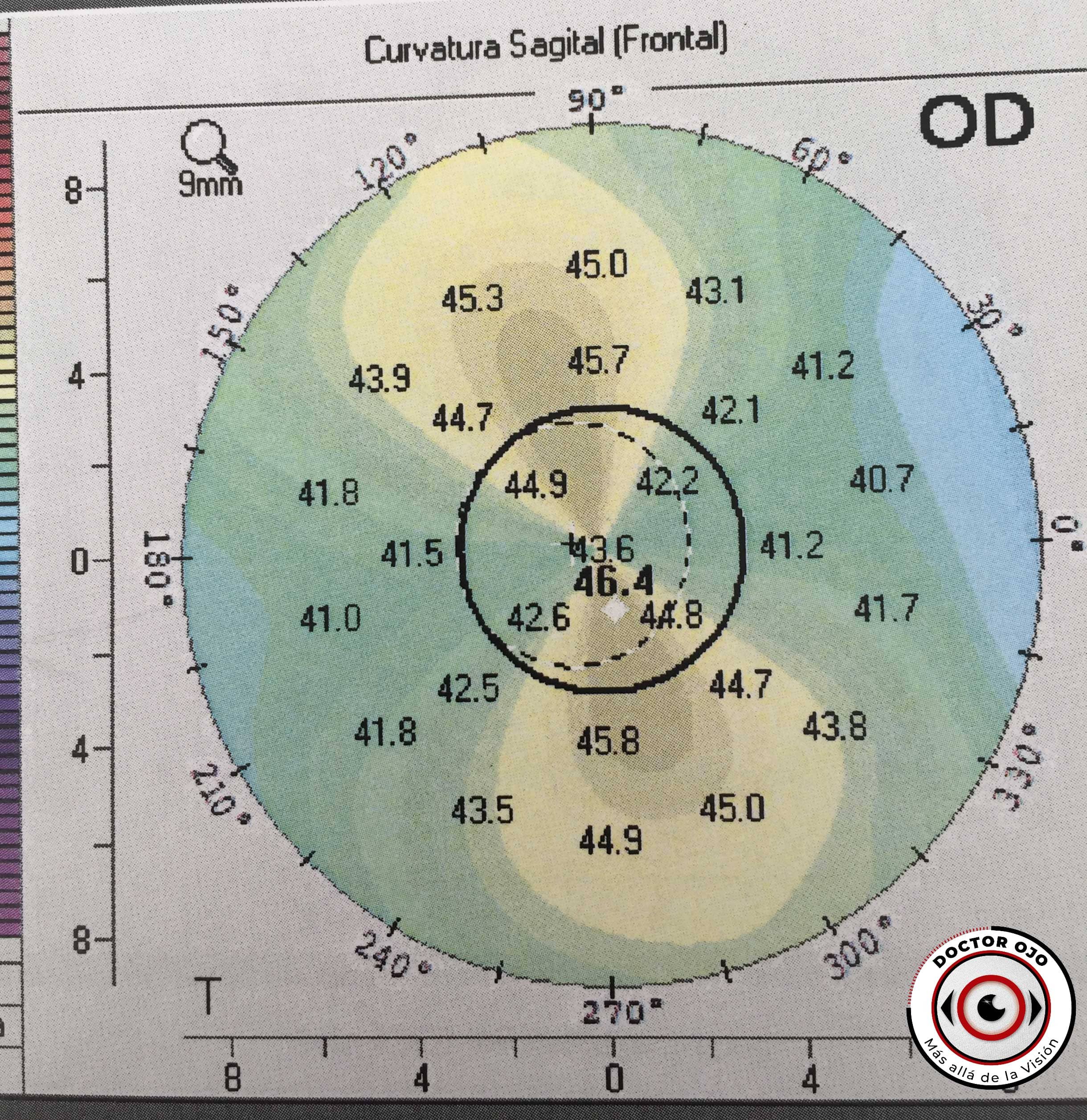 Topografía de córnea normal