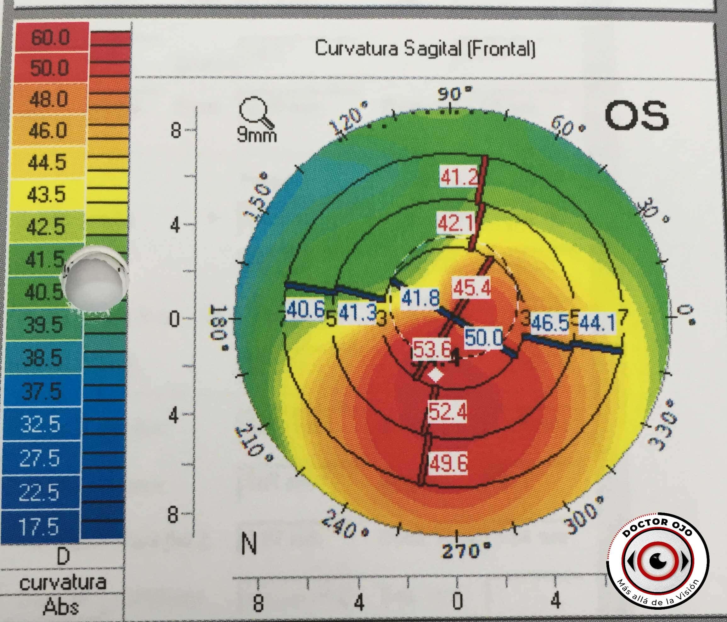 Topografía compatible con queratocono