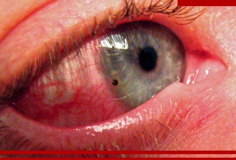 trauma ocular